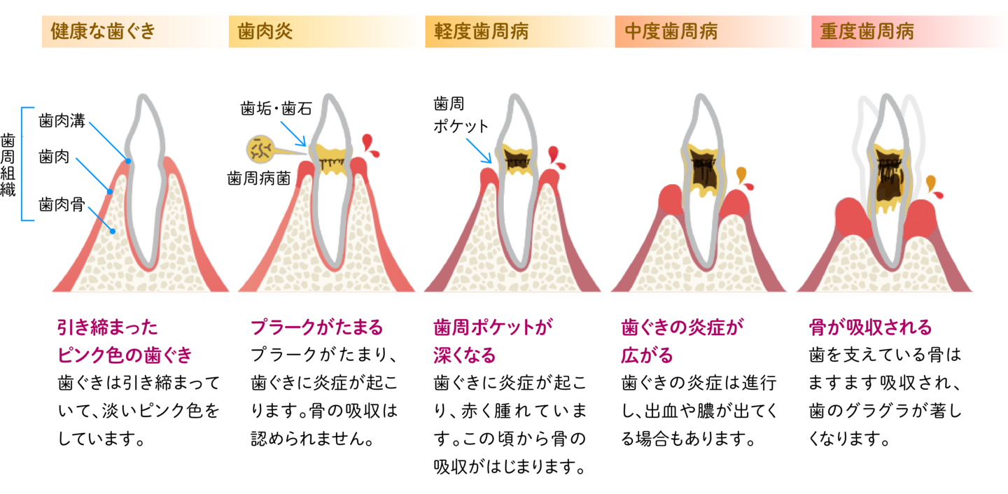 歯周病の進行図